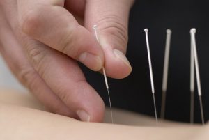 physiotherapy in littlehampton, physiotherapist, physio, arundel, rustington, rehab, taping, acupuncture, physiotherapist, needling, dry