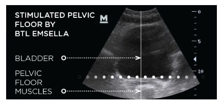 EmSella Bladder After strong pelvic floor treatment Littlehampton West Sussex, EmSella, EmSella in Littlehampton, EmSella West Sussex, EmSella South Coat, Pelvic Floor, Dysfunction, Sexual, Pain, Dryness, Prostate, Pee, Urine, Leak, Laugh, Bladder, ED, Erectile Dysfunction, Magnets, Kegel, Kegels, Health, Tone, Muscle, Symptom, Strength, Electromagnetic, HIFEM, Weak, weakened, stimulation, contraction, treatment, non-surgical, high-intensity, focused, pelvic, tightness, men, women, exercise, vagina, vaginal, sensation, orgasm, post, partum, pregnancy, tear, active, female, male, reduced, laxity, patient, boost, aging, childbirth, surgery, pads, kegal, catheterisation, FDA, BTL, intimate, menopause, Sussex, West Sussex, Chichester, Portsmouth, Southampton, hove, Brighton, Hampshire, Hants, Surrey, Arundel, Midhurst, petersfield, Littlehampton, bognor, worthing, Oving, Wittering, Emsworth, Hayling, Horsham, Waterlooville, Havant, Fareham, Westbourne, Lavant, Boxgrove, Petworth