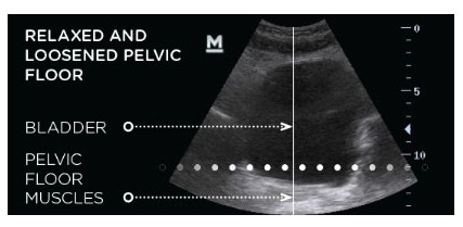 EmSella Bladder Before weak pelvic floor Treatment After Littlehampton West Sussex, EmSella, EmSella in Littlehampton, EmSella West Sussex, EmSella South Coat, Pelvic Floor, Dysfunction, Sexual, Pain, Dryness, Prostate, Pee, Urine, Leak, Laugh, Bladder, ED, Erectile Dysfunction, Magnets, Kegel, Kegels, Health, Tone, Muscle, Symptom, Strength, Electromagnetic, HIFEM, Weak, weakened, stimulation, contraction, treatment, non-surgical, high-intensity, focused, pelvic, tightness, men, women, exercise, vagina, vaginal, sensation, orgasm, post, partum, pregnancy, tear, active, female, male, reduced, laxity, patient, boost, aging, childbirth, surgery, pads, kegal, catheterisation, FDA, BTL, intimate, menopause, Sussex, West Sussex, Chichester, Portsmouth, Southampton, hove, Brighton, Hampshire, Hants, Surrey, Arundel, Midhurst, petersfield, Littlehampton, bognor, worthing, Oving, Wittering, Emsworth, Hayling, Horsham, Waterlooville, Havant, Fareham, Westbourne, Lavant, Boxgrove, Petworth
