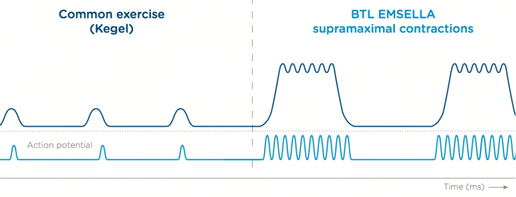 EmSella Contraction Wave VS Kegel Treatment Littlehampton West Sussex, Amelia Altneburger, Physiotherapist, Physio, Womens Health, Mummy MOT, EmSella, Pelvic Floor, Dysfunction, Sexual, Pain, Dryness, Prostate, Pee, Urine, Leak, Laugh, Bladder, ED, Erectile Dysfunction, Magnets, Kegel, Kegels, Health, Tone, Muscle, Symptom, Strength, Electromagnetic, HIFEM, Weak, weakened, stimulation, contraction, treatment, non-surgical, high-intensity, focused, pelvic, tightness, men, women, exercise, vagina, vaginal, sensation, orgasm, post, partum, pregnancy, tear, active, female, male, reduced, laxity, patient, boost, aging, childbirth, surgery, pads, kegal, catheterisation, FDA, BTL, intimate, menopause, Sussex, West Sussex, Chichester, Portsmouth, Southampton, hove, Brighton, Hampshire, Hants, Surrey, Arundel, Midhurst, petersfield, Littlehampton, bognor, worthing, Oving, Wittering, Emsworth, Hayling, Horsham, Waterlooville, Havant, Fareham, Westbourne, Lavant, Boxgrove, Petworth