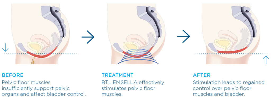 EmSella Female Pelvic Floor Improvement, EmSella, EmSella in Littlehampton, EmSella West Sussex, EmSella South Coat, Pelvic Floor, Dysfunction, Sexual, Pain, Dryness, Prostate, Pee, Urine, Leak, Laugh, Bladder, ED, Erectile Dysfunction, Magnets, Kegel, Kegels, Health, Tone, Muscle, Symptom, Strength, Electromagnetic, HIFEM, Weak, weakened, stimulation, contraction, treatment, non-surgical, high-intensity, focused, pelvic, tightness, men, women, exercise, vagina, vaginal, sensation, orgasm, post, partum, pregnancy, tear, active, female, male, reduced, laxity, patient, boost, aging, childbirth, surgery, pads, kegal, catheterisation, FDA, BTL, intimate, menopause, Sussex, West Sussex, Chichester, Portsmouth, Southampton, hove, Brighton, Hampshire, Hants, Surrey, Arundel, Midhurst, petersfield, Littlehampton, bognor, worthing, Oving, Wittering, Emsworth, Hayling, Horsham, Waterlooville, Havant, Fareham, Westbourne, Lavant, Boxgrove, Petworth