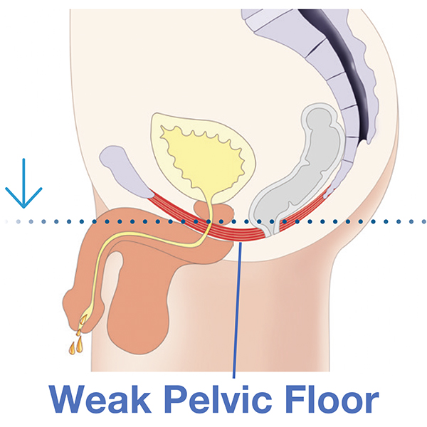 Littlehampton Male ED Treatment, EmSella, Pelvic Floor, Dysfunction, Sexual, Pain, Dryness, Prostate, Pee, Urine, Leak, Laugh, Bladder, ED, Erectile Dysfunction, Magnets, Kegel, Kegels, Health, Tone, Muscle, Symptom, Strength, Electromagnetic, HIFEM, Weak, weakened, stimulation, contraction, treatment, non-surgical, high-intensity, focused, pelvic, tightness, men, women, exercise, vagina, vaginal, sensation, orgasm, post, partum, pregnancy, tear, active, female, male, reduced, laxity, patient, boost, aging, childbirth, surgery, pads, kegal, catheterisation, FDA, BTL, intimate, menopause, Sussex, West Sussex, Chichester, Portsmouth, Southampton, hove, Brighton, Hampshire, Hants, Surrey, Arundel, Midhurst, petersfield, Littlehampton, bognor, worthing, Oving, Wittering, Emsworth, Hayling, Horsham, Waterlooville, Havant, Fareham, Westbourne, Lavant, Boxgrove, Petworth