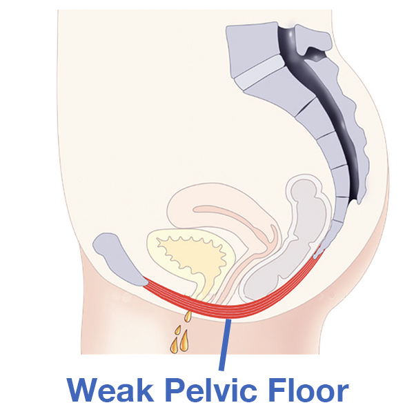 WOMEN EmSella Pelvic Floor Dysfunction Treatment Littlehampton weak pelvic floor, EmSella, EmSella in Littlehampton, EmSella West Sussex, EmSella South Coat, Pelvic Floor, Dysfunction, Sexual, Pain, Dryness, Prostate, Pee, Urine, Leak, Laugh, Bladder, ED, Erectile Dysfunction, Magnets, Kegel, Kegels, Health, Tone, Muscle, Symptom, Strength, Electromagnetic, HIFEM, Weak, weakened, stimulation, contraction, treatment, non-surgical, high-intensity, focused, pelvic, tightness, men, women, exercise, vagina, vaginal, sensation, orgasm, post, partum, pregnancy, tear, active, female, male, reduced, laxity, patient, boost, aging, childbirth, surgery, pads, kegal, catheterisation, FDA, BTL, intimate, menopause, Sussex, West Sussex, Chichester, Portsmouth, Southampton, hove, Brighton, Hampshire, Hants, Surrey, Arundel, Midhurst, petersfield, Littlehampton, bognor, worthing, Oving, Wittering, Emsworth, Hayling, Horsham, Waterlooville, Havant, Fareham, Westbourne, Lavant, Boxgrove, Petworth