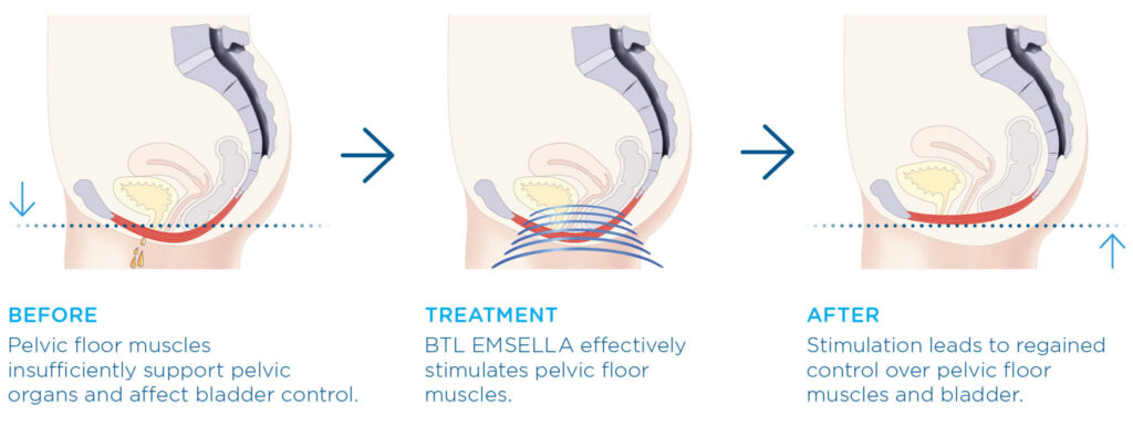 EmSella Female Pelvic Floor Improvement EmSella Littlehampton Dysfunction Treatment Physiotherapy