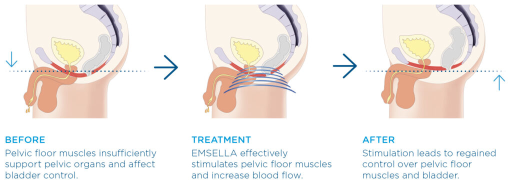 EmSella Male Pelvic Floor Improvement Treatment EmSella Chair Littlehampton West Sussex